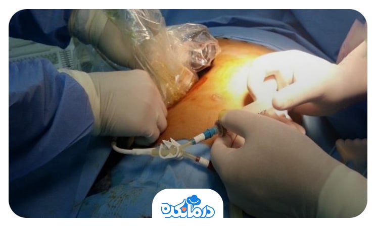  پزشکی که در حال تخلیه آبسه کبدی از طریق جراحی است.