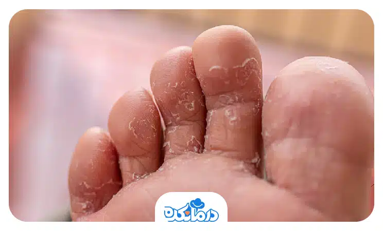 انگشتان پا که دچار پای ورزشکار (Athlete's Foot) شده‌اند.