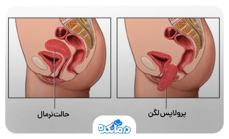 تصویری از پرولاپس لگن