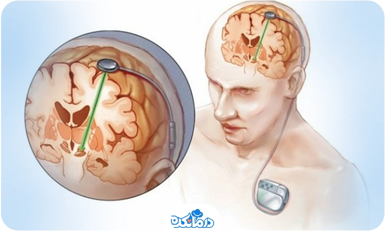 تصویر دستگاه تحریک‌کننده عصبی متصل به مغز