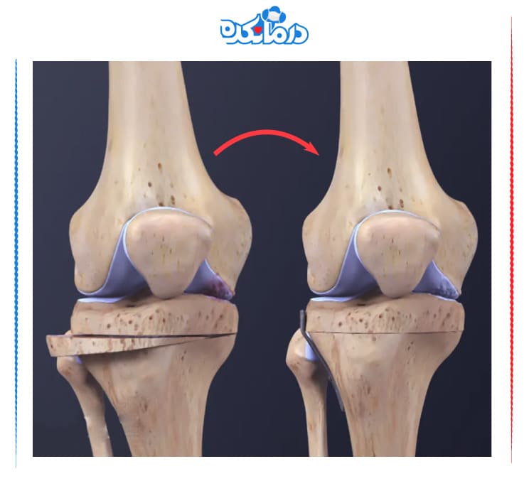 استئوتومی تیبیا