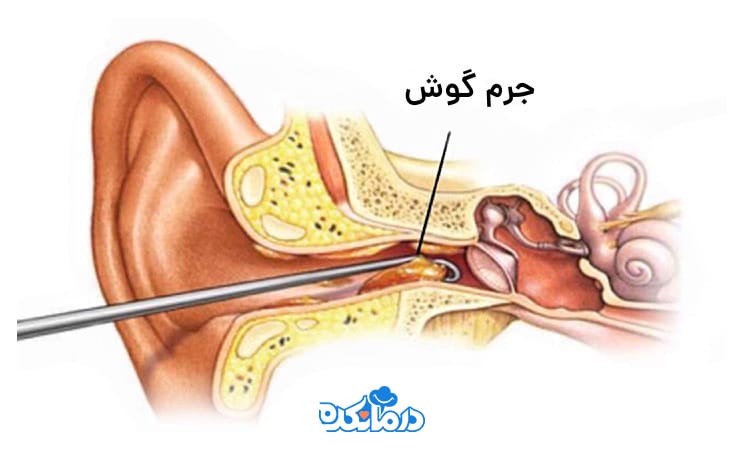 تصویر گرافیکی از گوش که مجرای آن نشان دهنده تمجع جرم است