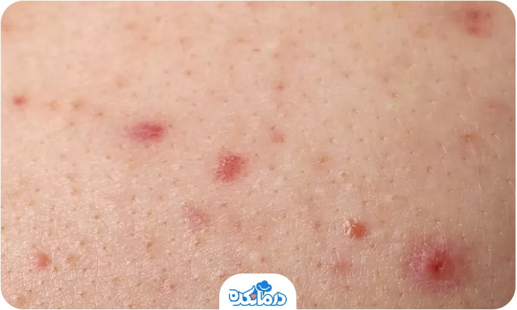 فولیکولیت ناحیه باسن