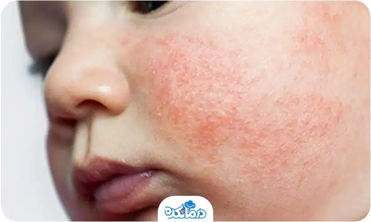 یک کودک مبتلا به اگزما