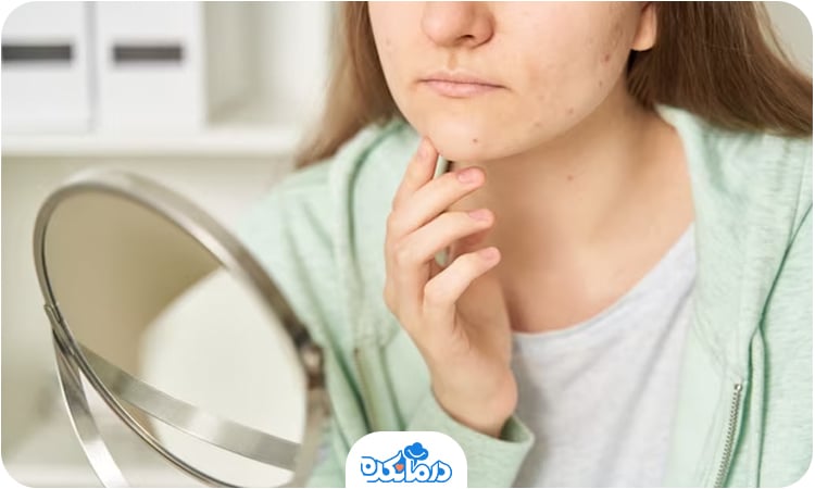 یک خانم پوست صورت خود را در آینه می‌بیند که حاوی جوش است. 