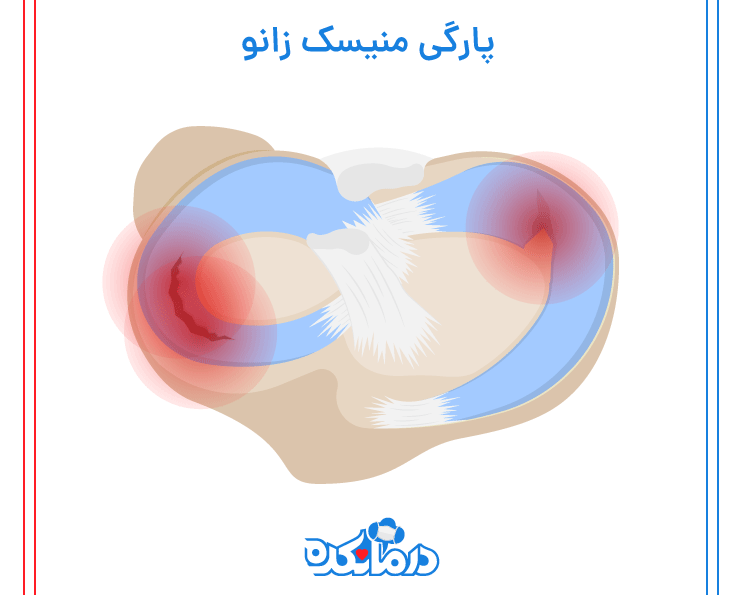 زمانیکه منیسک زانو پاره شد با خطراتی همراه است|التیاما
