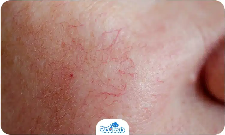 رگ‌های عنکبوتی در چهره را می‌بینید.