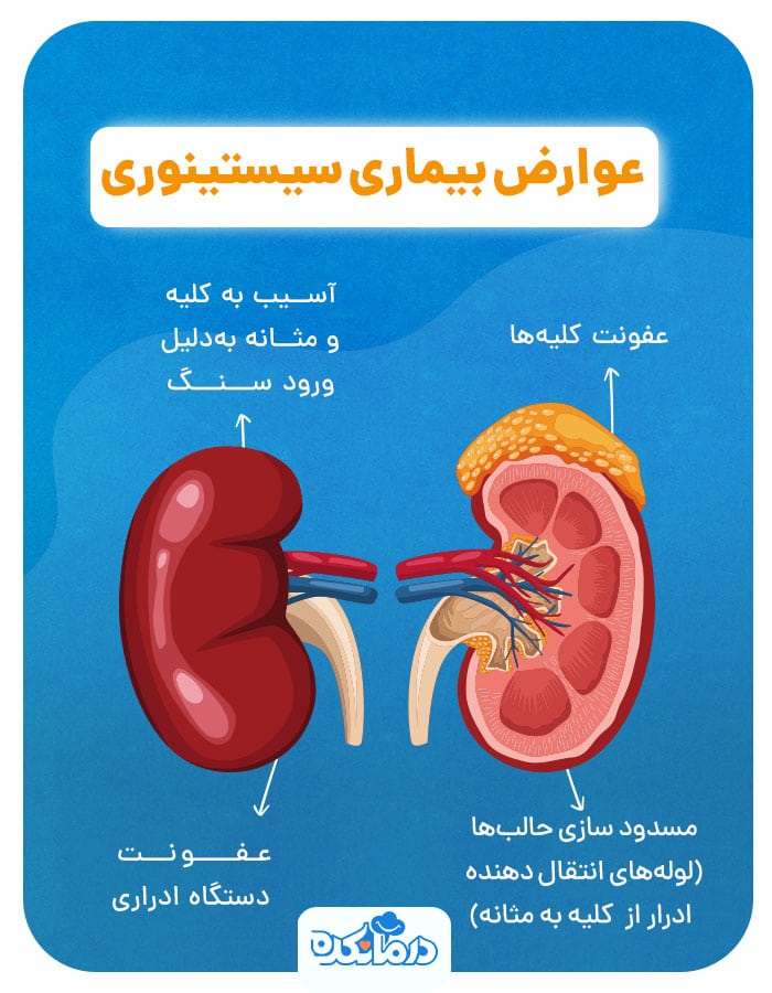  اینفوگرافی از عوارض بیماری سیستینوری
