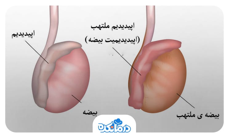  تصویر بیضه سالم و متورم دردناک