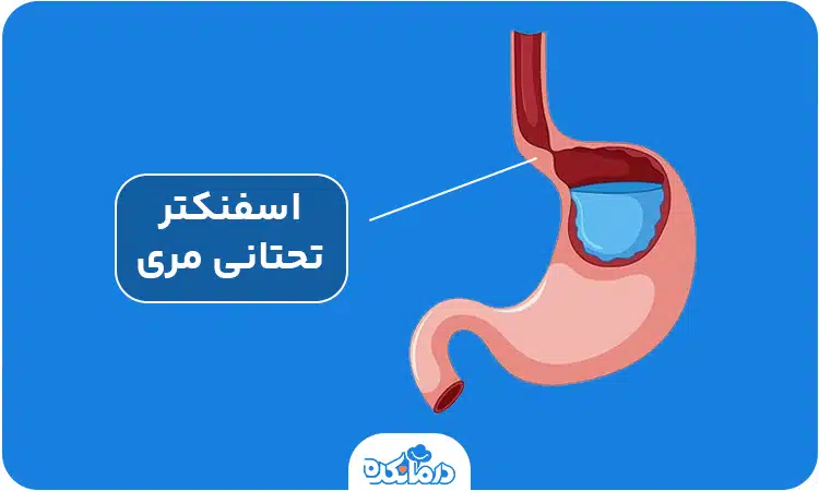 تصویر از مری و معده که اسفنکتر تحتانی مری را نشان می‌دهد.