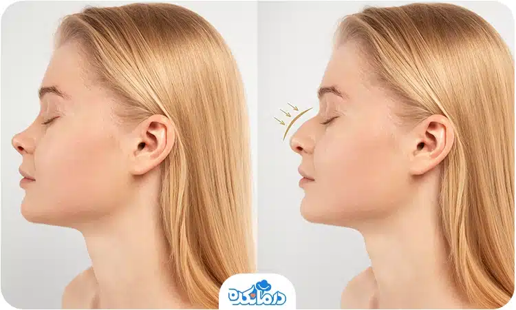 قبل و بعد جراحی بینی فانتزی را می‌بینید.