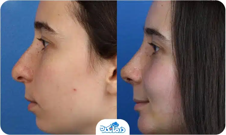 تغییرات بینی قبل و بعد از جراحی زیبایی بینی 