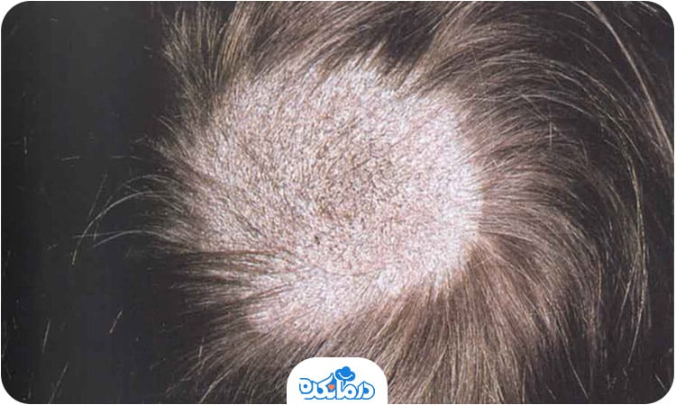 یک سر که قسمت بالای آن دچار ریزش مو شده است 