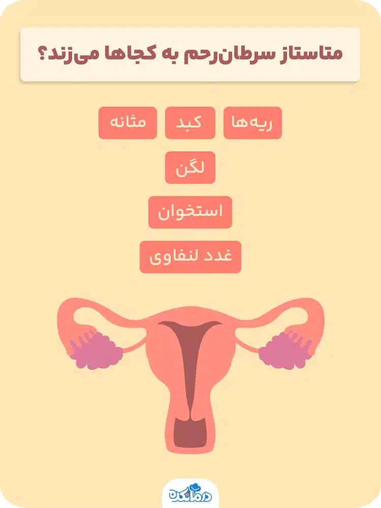 اینفوگرافیک متاستاز سرطان‌رحم به کجاها می‌زند؟ 