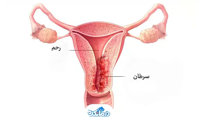 تصویر گرافیکی از رحم دارای بافت سرطانی