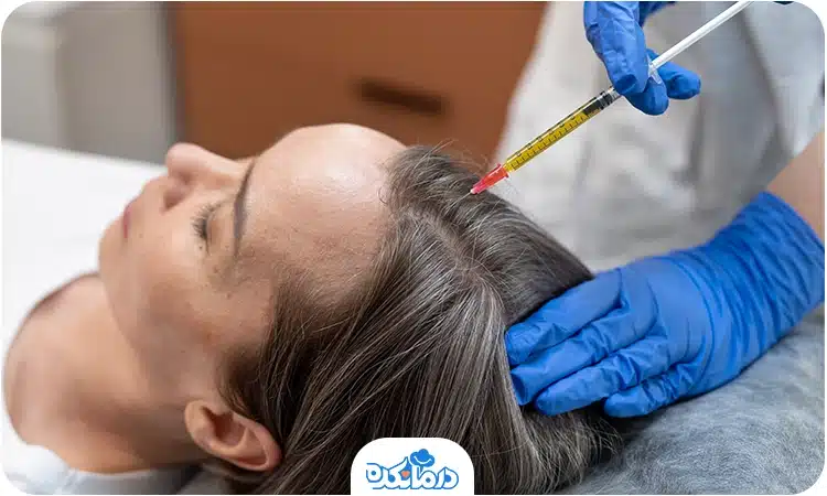 آلترنیتیو: تصویر تزریق مزوتراپی با سوزن ظریف و بلند به کف سر یک خانم
