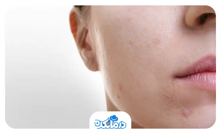 تصویر فردی که روی پوست او جای جوش و لک ایجاد شده است.