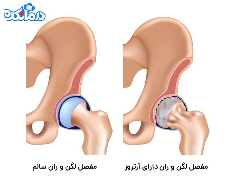  بروز التهاب ناشی از آرتروز در مفصل ران و لگن