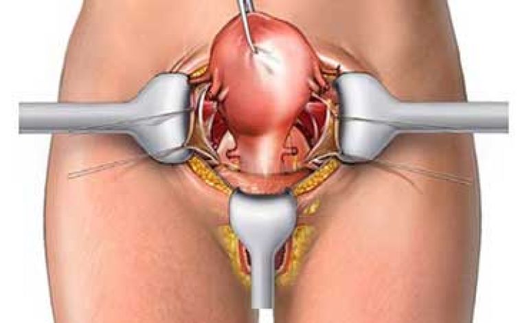 تصویری برای نشان دادن هیسترکتومی شکمی و نحوه انجام آن