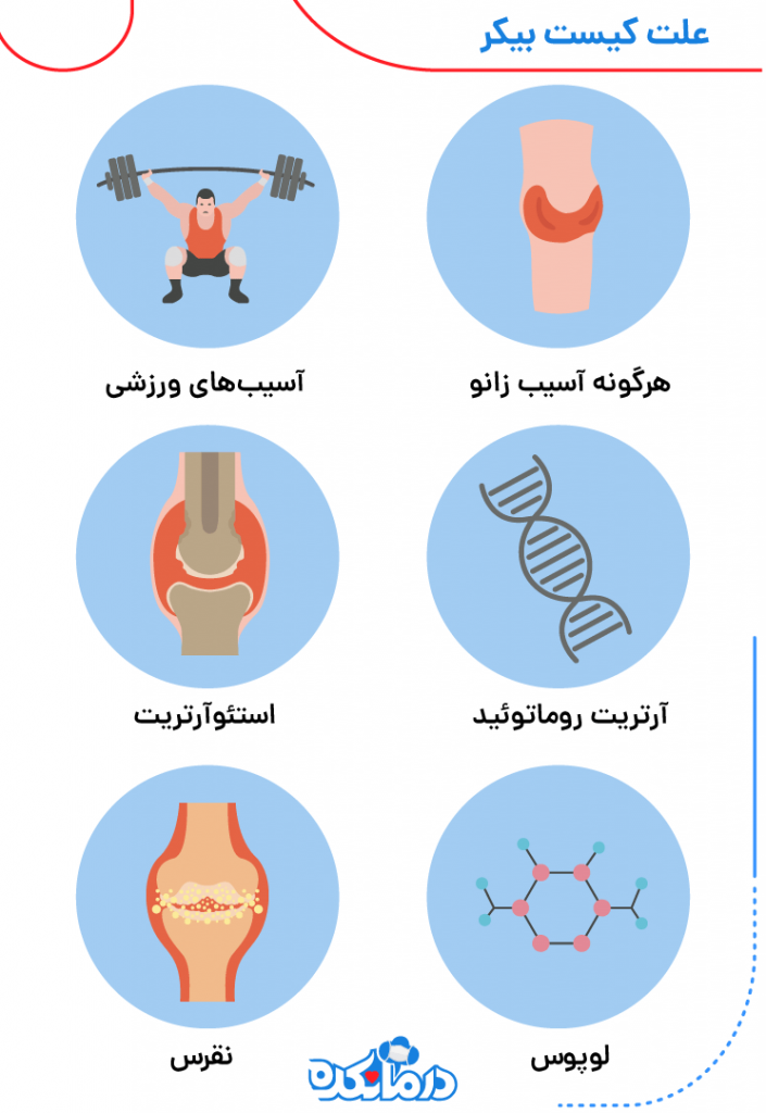 ۶ علت کیست پاپلیتئال 